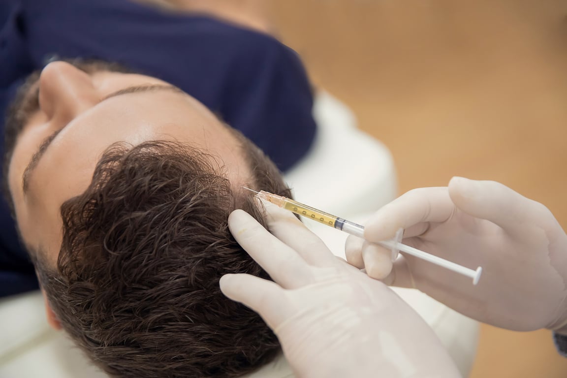 Hair mesotherapy or scalp prp: Platelet-rich plasma procedure. Beautician doctor makes injections in the man head for hair growth to prevent hair loss and baldness